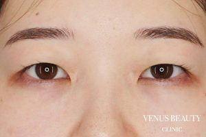 二重まぶた埋没法 施術前