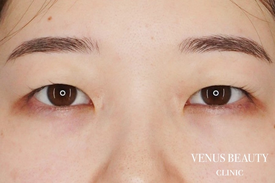 二重まぶた埋没法 施術前