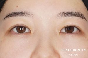 二重まぶた埋没法 施術後