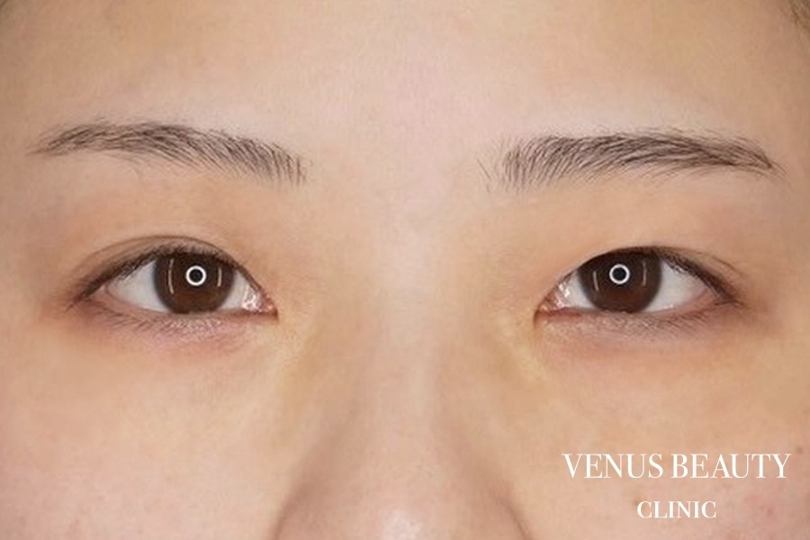 二重まぶた埋没法 施術前