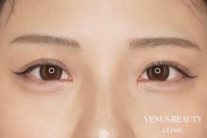 二重まぶた埋没法 施術後
