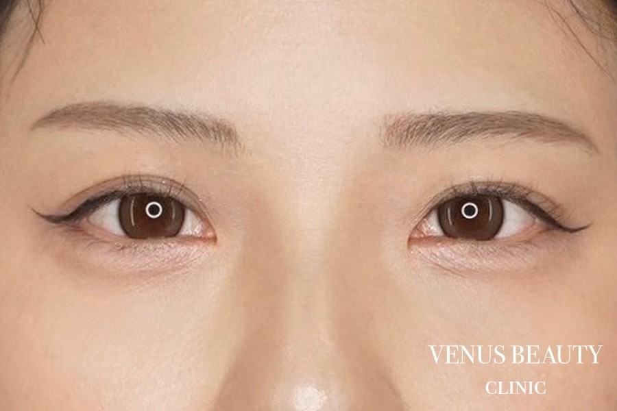 二重まぶた埋没法 施術後