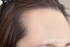 ヘアアートメイク症例一覧 施術前