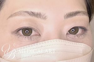 眉アートメイク症例一覧 施術後