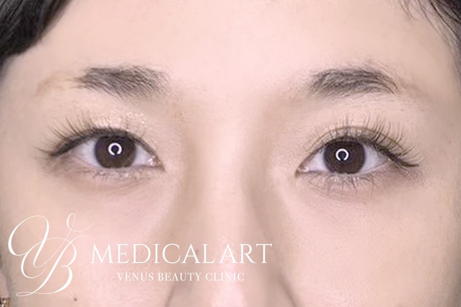 眉アートメイク症例一覧 施術前