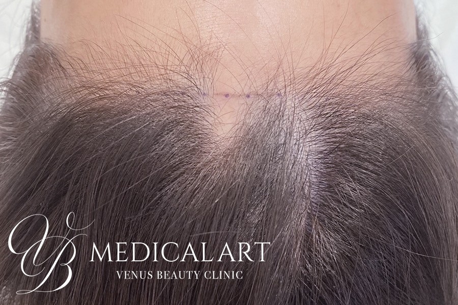 ヘアアートメイク症例一覧 施術前