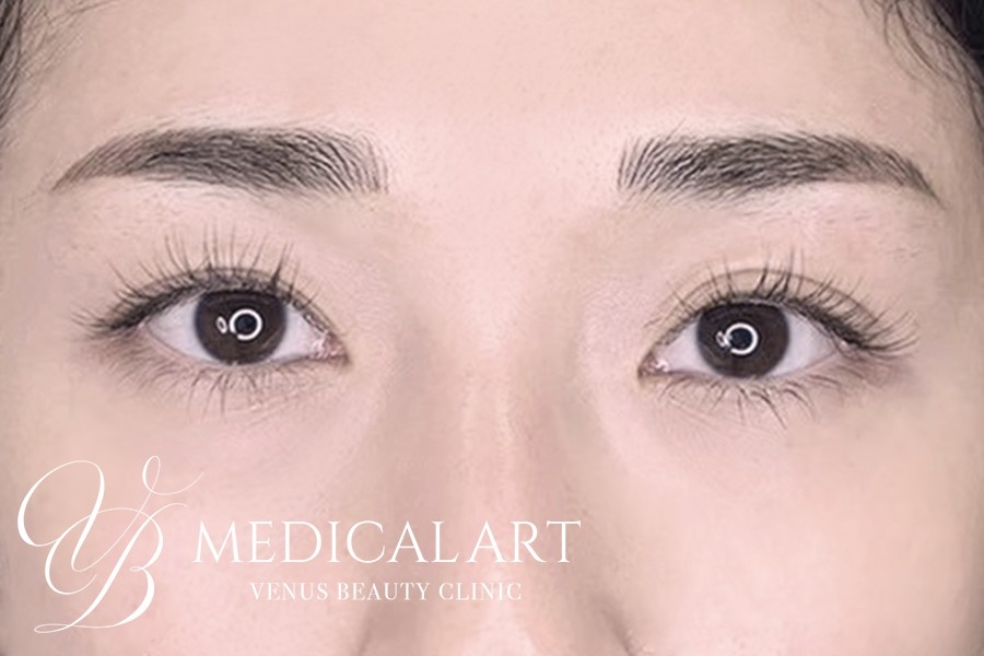 眉アートメイク症例一覧 施術後