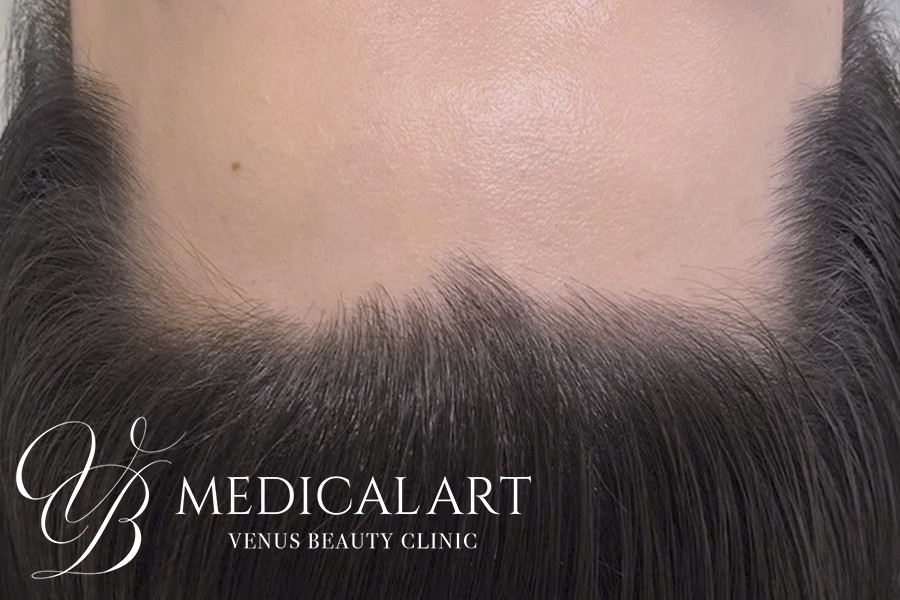 ヘアアートメイク症例一覧 施術前