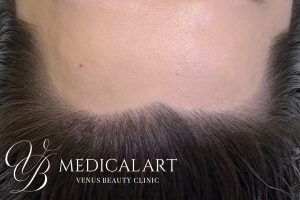 ヘアアートメイク症例一覧 施術後