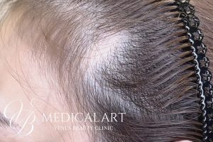 ヘアアートメイク症例一覧 施術前