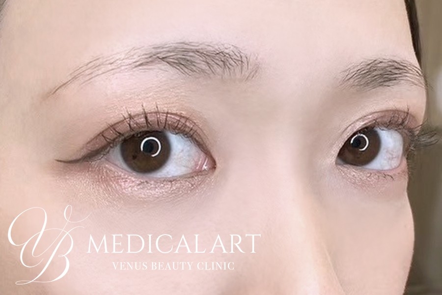 眉アートメイク症例一覧 施術前