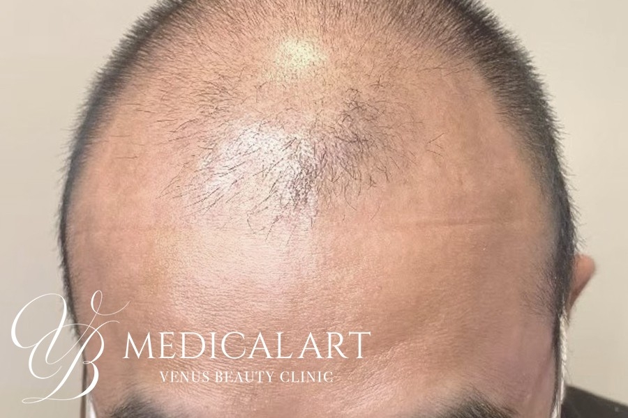 ヘアアートメイク症例一覧 施術前