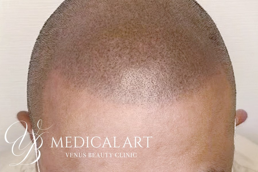 ヘアアートメイク症例一覧 施術後