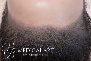 ヘアアートメイク症例一覧 施術後