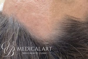 ヘアアートメイク症例一覧 施術前