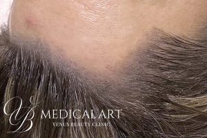 ヘアアートメイク症例一覧 施術後