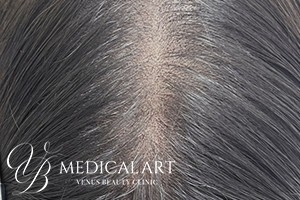 ヘアアートメイク症例一覧 施術後