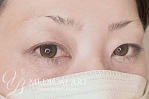 眉アートメイク症例一覧 施術前