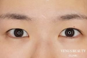 二重まぶた埋没法 施術前