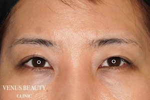 眼瞼下垂症 施術後