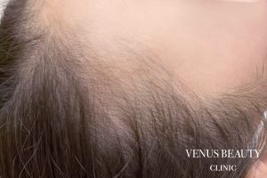 ヘアアートメイク症例一覧 施術前