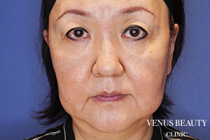 フルフェイスリフト 施術前