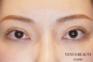 目頭切開 施術後