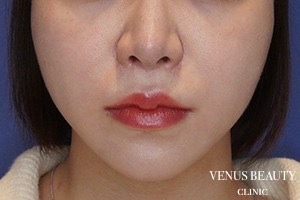 人中短縮術 施術後