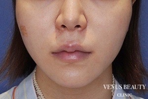 人中短縮術 施術前