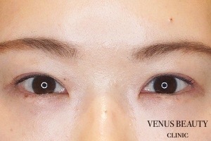 二重まぶた全切開法 施術後