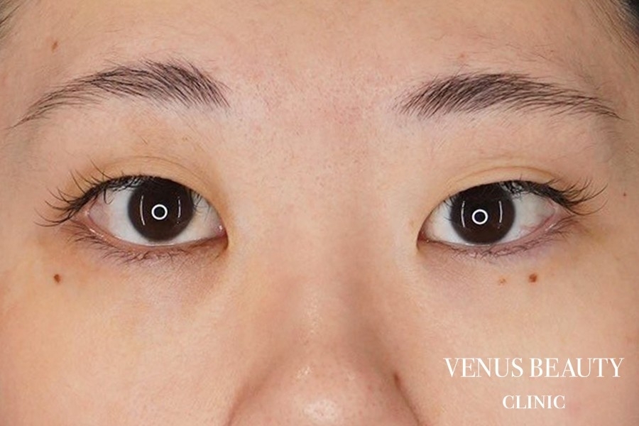 目頭切開 施術前