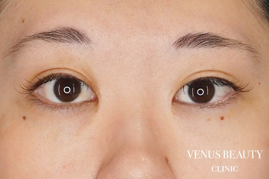 目頭切開 施術後