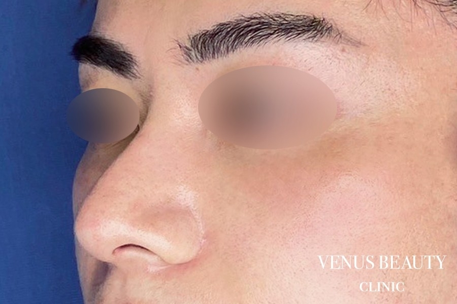 耳介軟骨移植 施術後