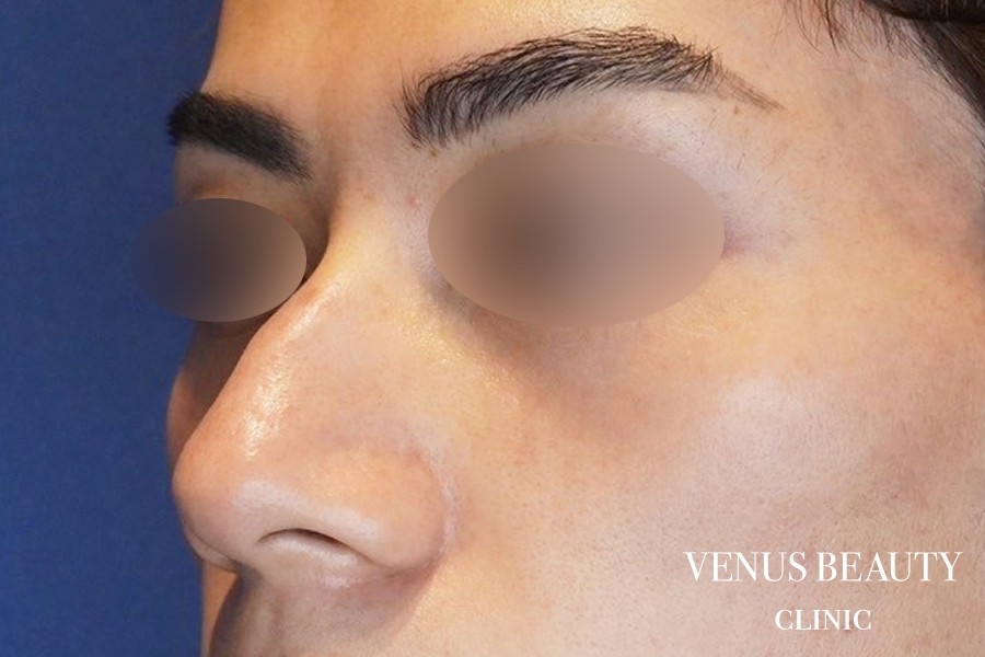 耳介軟骨移植 施術前