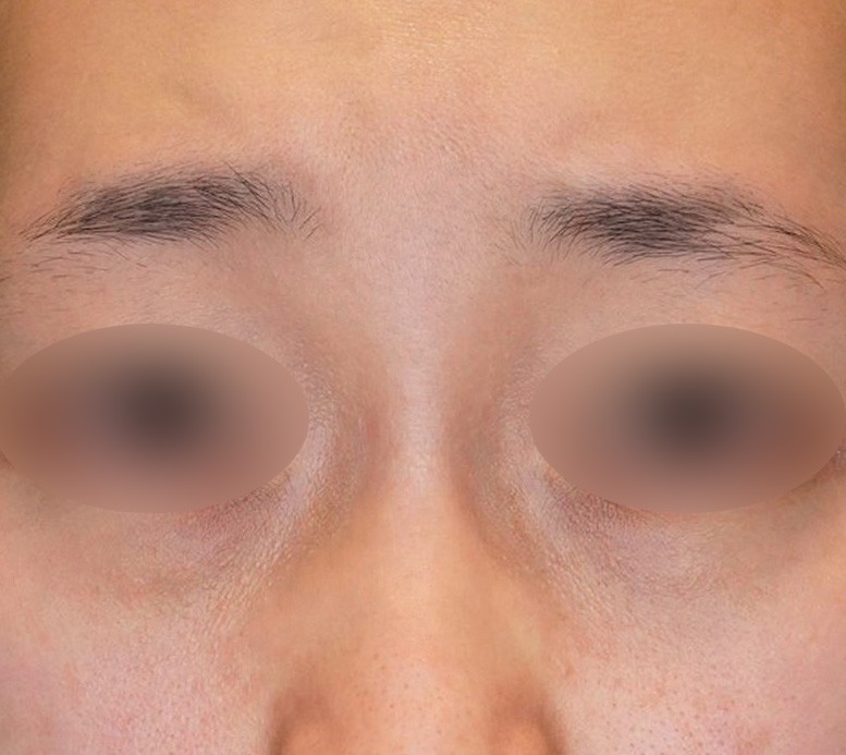 下まぶたのたるみとり 施術前