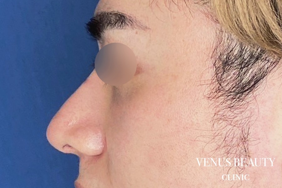 耳介軟骨移植 施術後