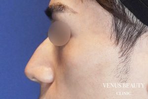 耳介軟骨移植 施術前