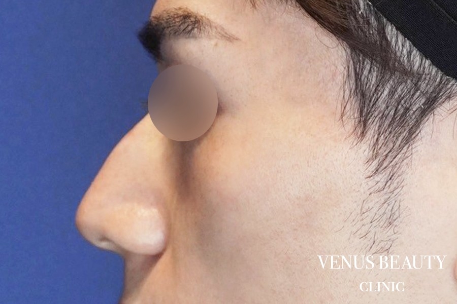 耳介軟骨移植 施術前