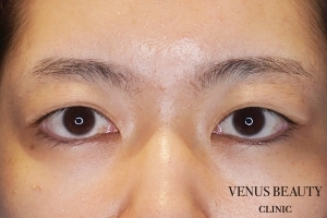 二重まぶた全切開法 施術前