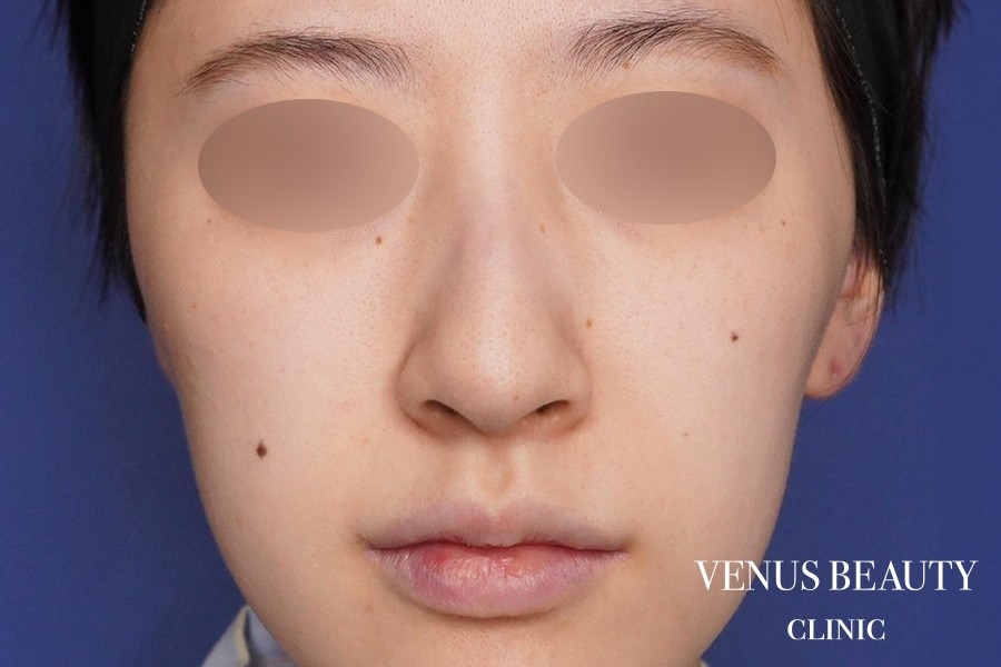 骨切幅寄せ 施術前