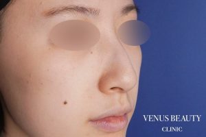 耳介軟骨移植 施術前