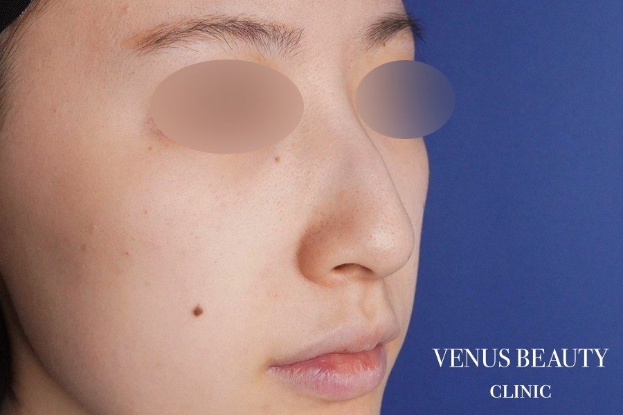 耳介軟骨移植 施術前