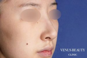 耳介軟骨移植 施術後