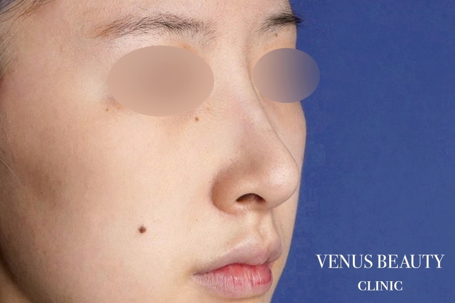 耳介軟骨移植 施術後