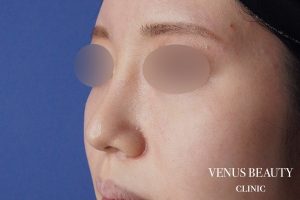 わし鼻・段鼻修正 ハンプ切除 施術後