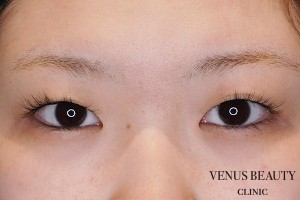二重まぶた全切開法 施術前