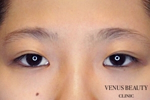 目頭切開 施術前