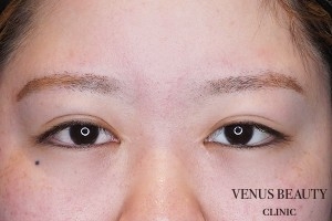 目頭切開 施術前