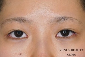 目頭切開 施術後