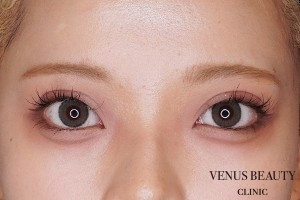 二重まぶた全切開法 施術後